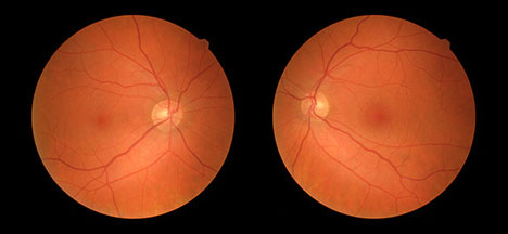 Retinal Photography